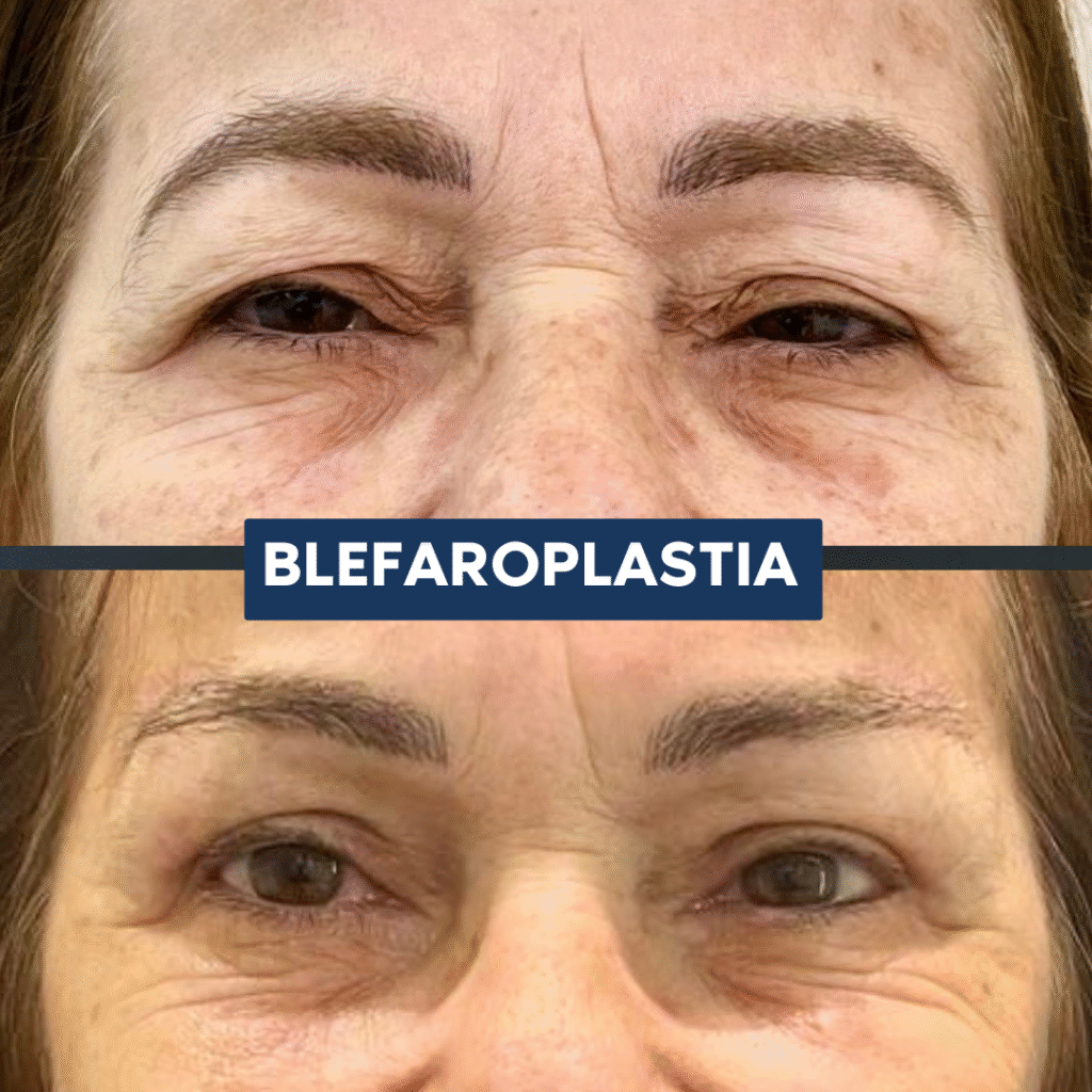 BLEFAROPLASTIA
